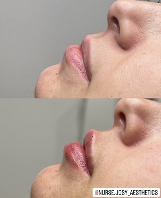 Lip Filler