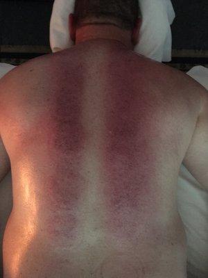 A client's back after a medicupping session...out with old stagnant blood and toxins, in with healthy circulation.