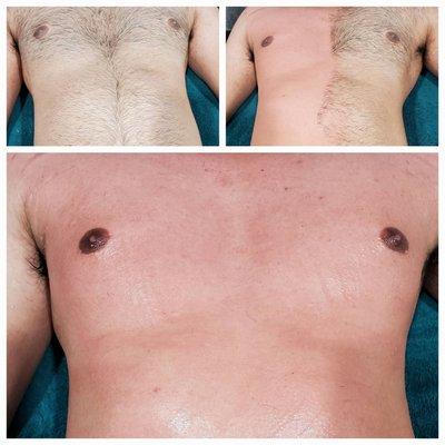 Before, during and after chest/stomach wax.