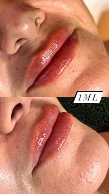 1ML lip filler done with the Hyaluron Pen