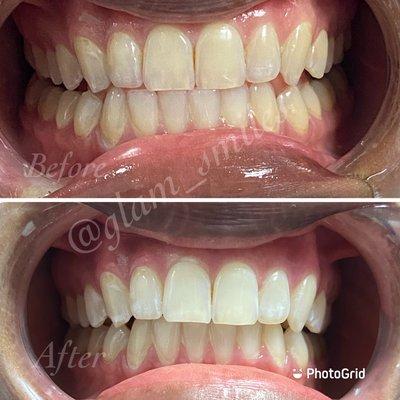 Triple session teeth whitening