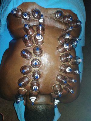 Cupping therapy. Helps relieve muscle tightness, range of motion, blood circulation, release toxins, pain reduction and more.