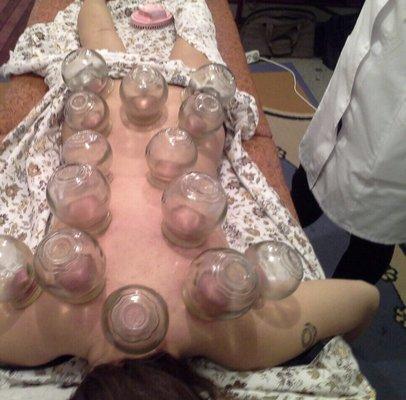 Cupping for stress relieve, inflammation, cold and sore muscle