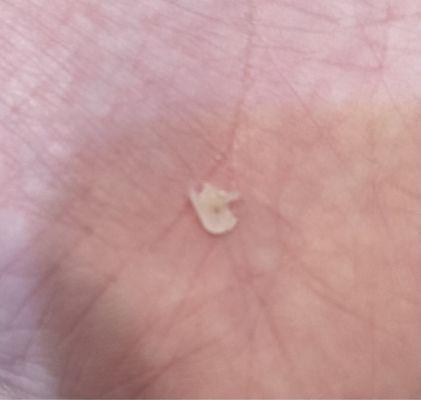 A chunk of something found in my mouth after a crown was put on