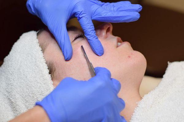 Image of a dermaplaning treatment in progress with a patient