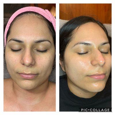 Facial before and after