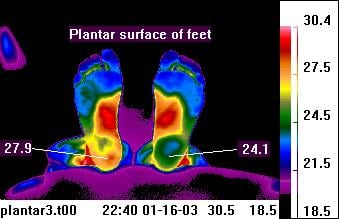 Thermal Image of the feet. Red indicates areas of increased blood flow, blue would be areas of decreased. Should be symmetrical.