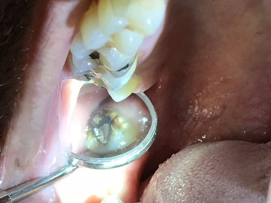 Rotten tooth causing illness