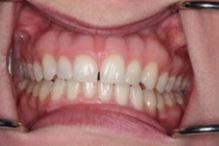 Before: Veneers