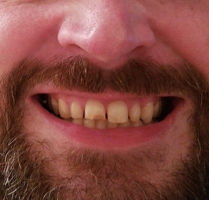 Before- chipped, uneven wear with crooked, gapped teeth.