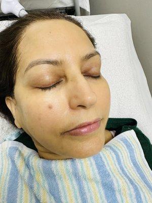 Face rejuvenation