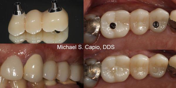 Dental Implant bridge placed by Dr Capio.