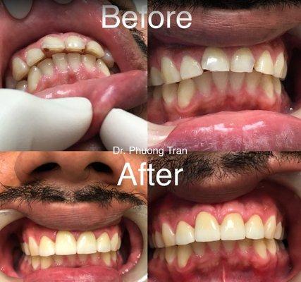 Patient had decayed, chipped front teeth and crooked smile. Porcelain crowns were made on four front teeth.