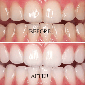 Teeth whitening/Bleaching