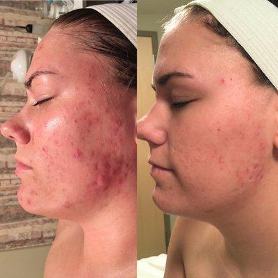 Microneedling after 2 treatments