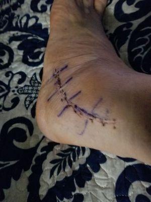 This is my ankle 4 weeks after surgery for a ruptured perineal tendon.