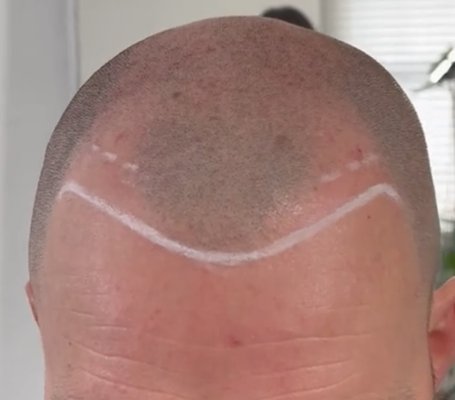 Scalp Micropigmentation