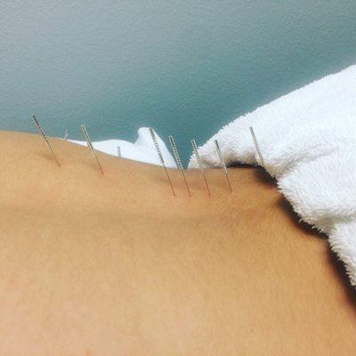 Functional Dry Needling Techniques to reduce back pain.  #innovation #kinetacore