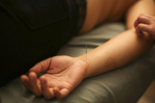 Part of an acupuncture treatment