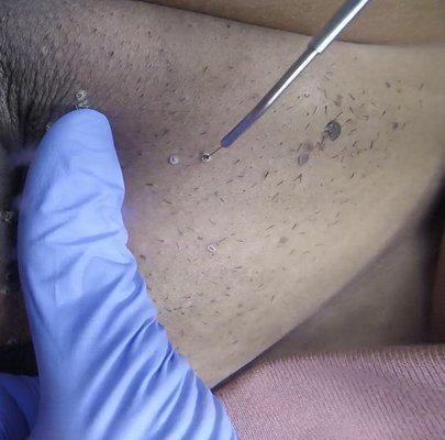 Pubic Area Skin Tag Removal