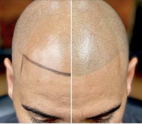 Scalp micropigmentation a permanent solution for hair loss