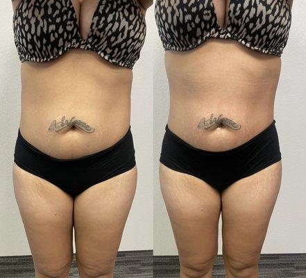 Ultrasonic Cavitation before and after!