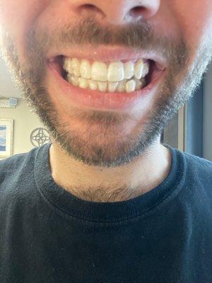 Invisalign