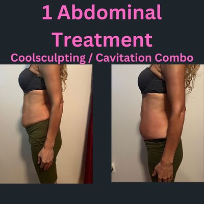 This was one abdominal treatment, coolsculpting and cavitation used together give great desults.