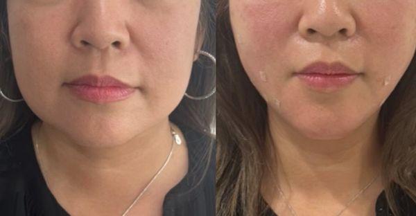 Masseter Reduction Botox