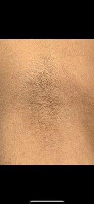 Before photo of underarm sugaring hair removal