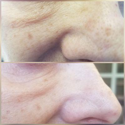 Microneedling and IPL