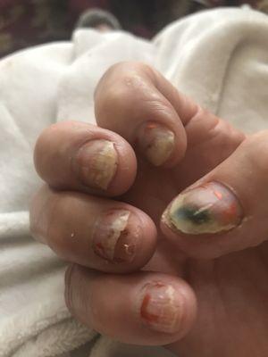 1 month after acrylics by Lee Nails