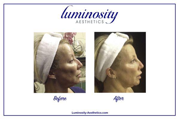 Liquid Rhinoplasty.