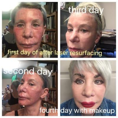 Last Thursday had laser resurfacing and documented the process. Dr Jay Rosenberg is the best. No pain and lots of gain.