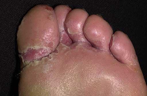 Athlete's Foot