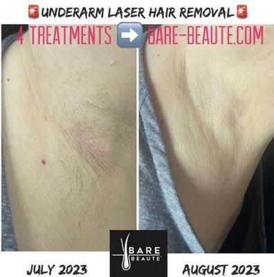 Laser hair removal treatment.