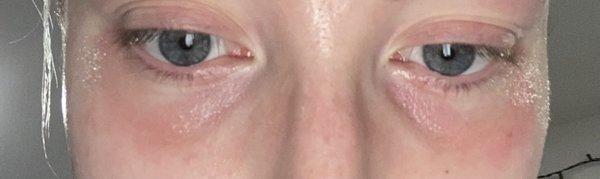 After she removed the lashes that were so uneven, different lengths on each eye and blotchy.