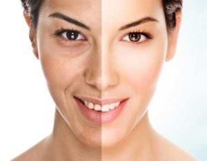 Microdermabrasion! http://www.medimeinskincare.com/