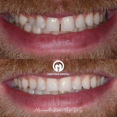 This patient was able to achieve a straighter smile in as little as 6 months with Invisalign!