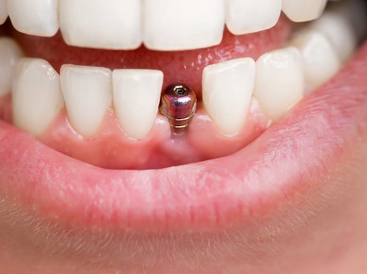 Dental Implant Abutment