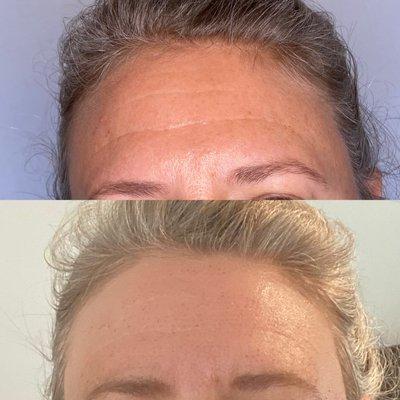 Before and After Plasma Skin Tightening. 8 days