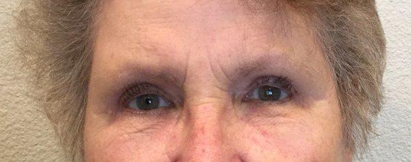 After pics of upper eyelid surgery