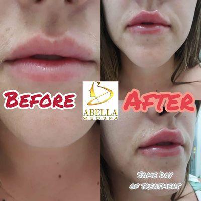 Lips augmentation