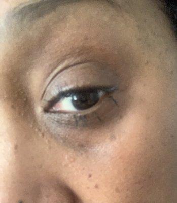 Right  Eye 8 days later