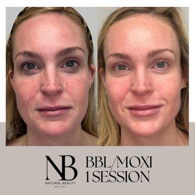 BBL & Moxi work great together to enhance your skin's texture and tone. Book a FREE consultation today!