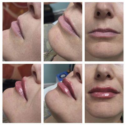 Dermal fillers.