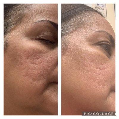 After 2 treatments of Microneedling.