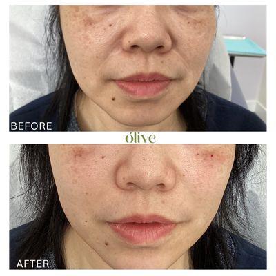 Lower face rejuvenation with HA filler.