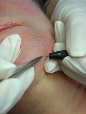 Electrolysis chin hair removal