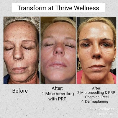 Before and after treatments at Thrive Wellness. Microneedling with PRP provides amazing results for skin! $500 Now. (Value $1500)